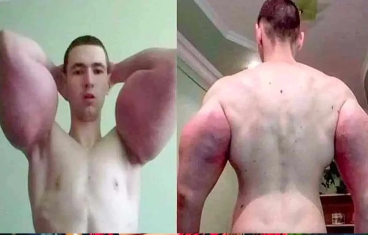 Popeye humano podrían amputarle los brazos