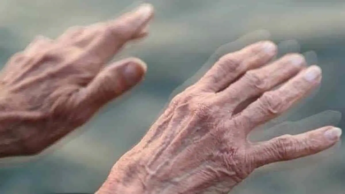 Prueban nuevo tratamiento contra el mal de Parkinson