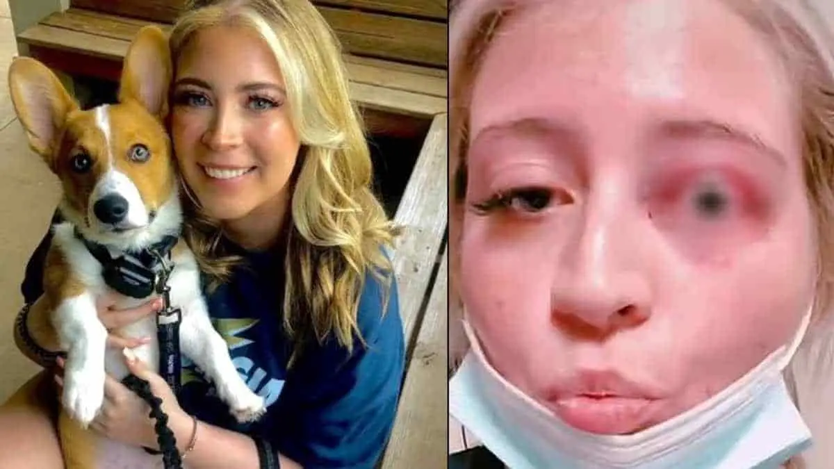 Perro chihuahua le arranca el párpado a jovencita que lo acarició