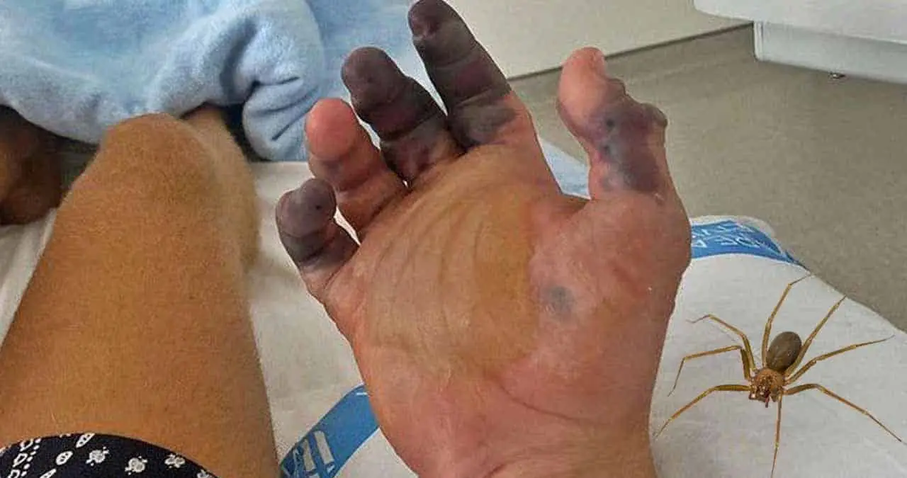 Le amputan dos dedos por mordedura de araña violinista