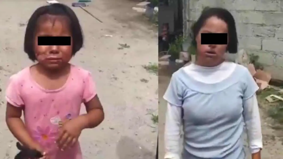 VIDEO. Quema a su hija con Síndrome de Down por comprar dulces