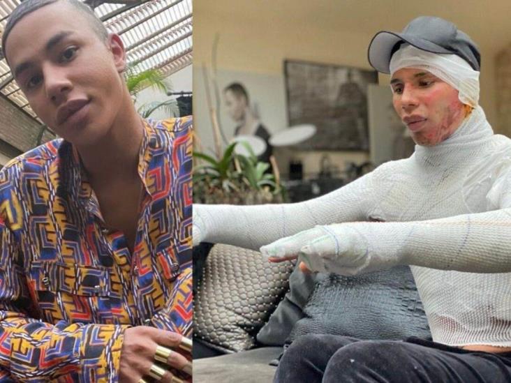 Olivier Rousteing comparte brutal imagen de su tragedia Olivier Rousteing comparte brutal imagen de su tragedia