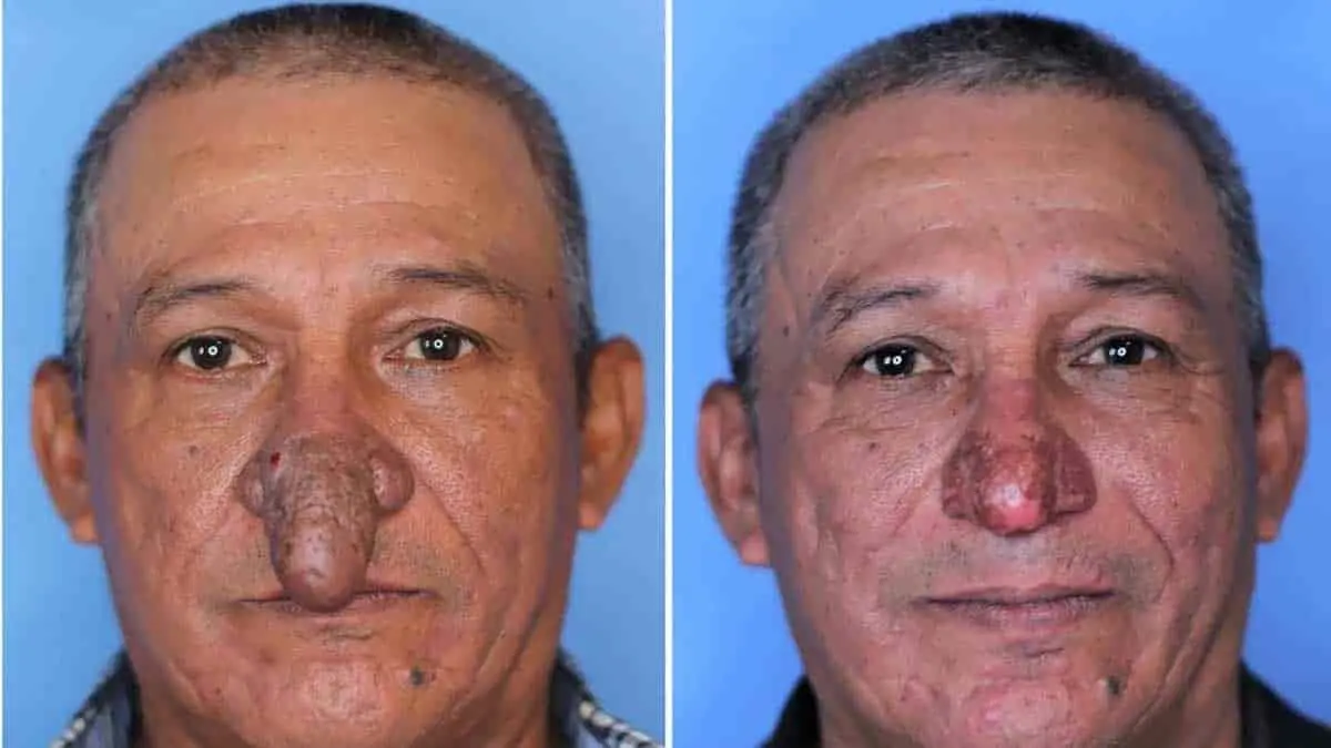 Cirujano regala cirugía y cambia la vida de humilde obrero