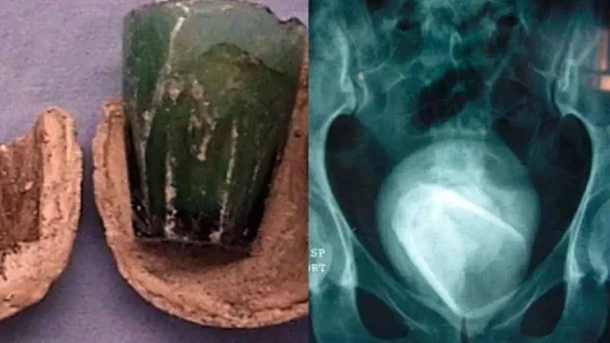Médico encuentra un vaso de vidrio en la vejiga de una mujer