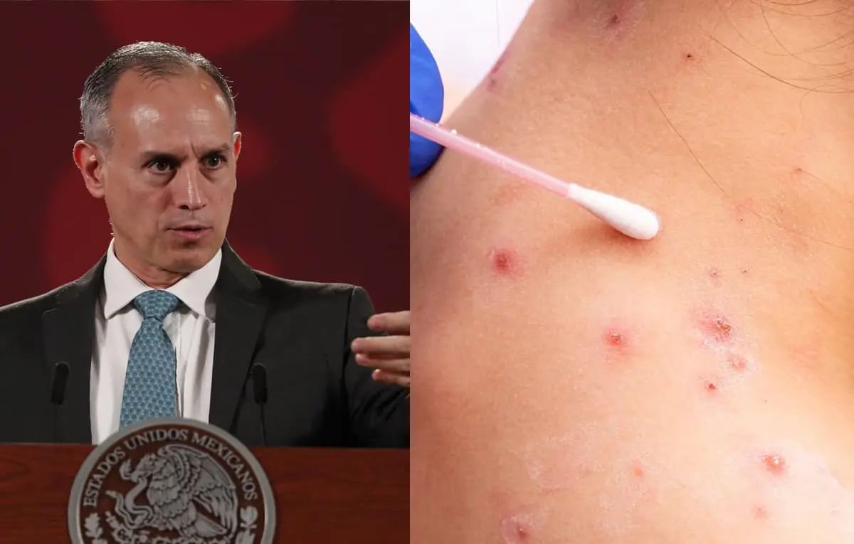 Van 60 casos de viruela del mono en México