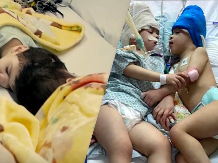Separan a hermanos siameses de 3 años unidos por la cabeza Separan a hermanos siameses de 3 años unidos por la cabeza