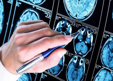 Descubren posible fraude en investigación sobre el Alzheimer