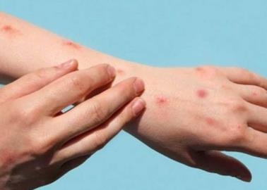 Descartan caso de viruela del mono en Hermosillo