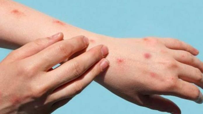 Descartan caso de viruela del mono en Hermosillo Descartan caso de viruela del mono en Hermosillo