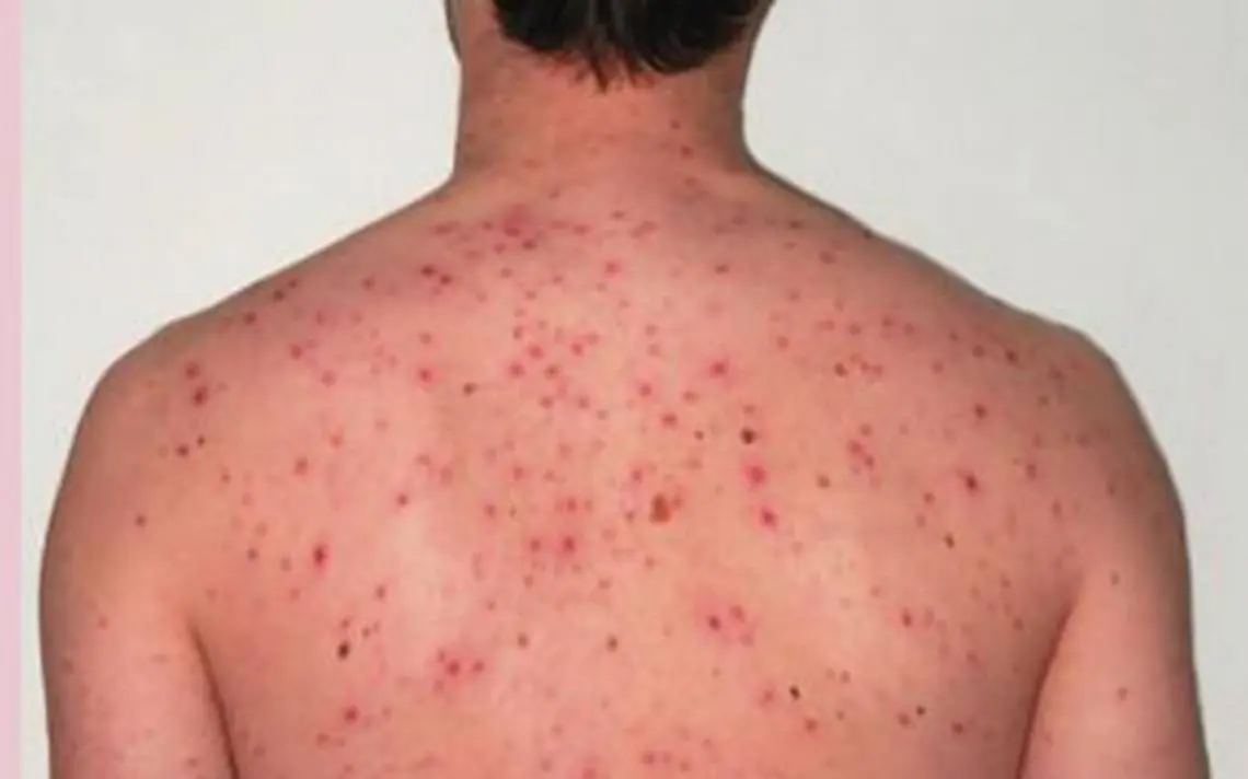 Aumentan en 2022 casos de rickettsia
