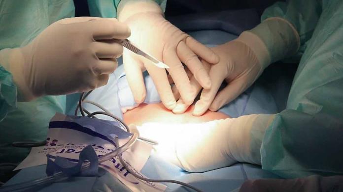 Médicos sacan desodorante del vientre de un hombre Médicos sacan desodorante del vientre de un hombre