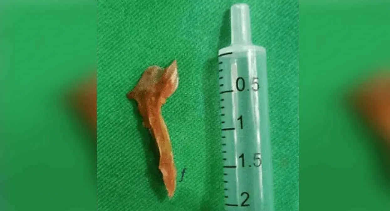 Muere tras tragarse una espina de pescado; le provocó infección