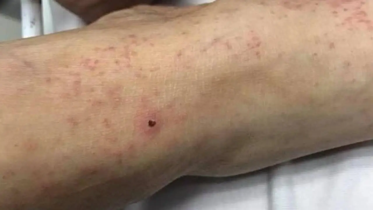Sube a 12 casos de rickettsia