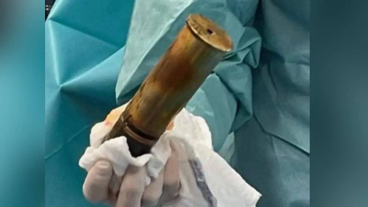 Llega a hospital anciano con bomba explosiva atorada en el recto