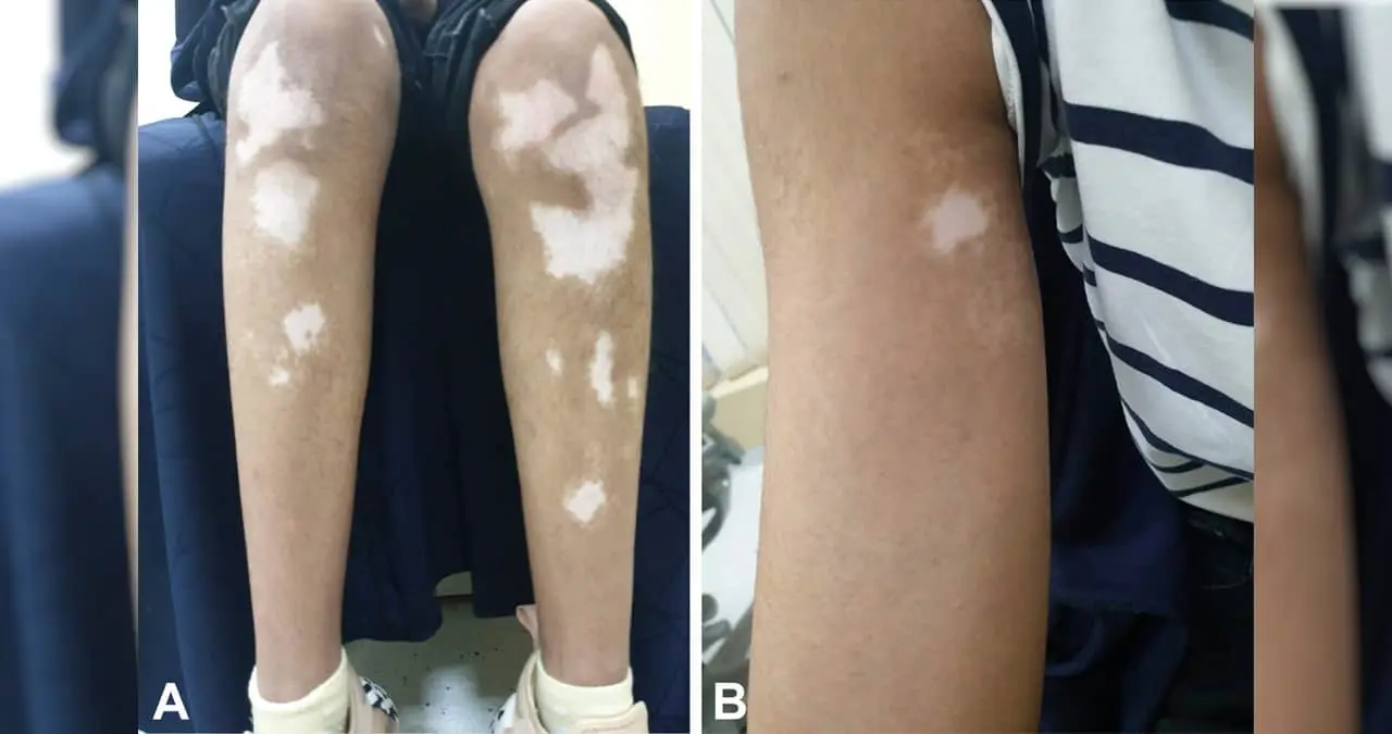 Autorizan venta de crema para tratar el vitíligo