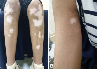 Autorizan venta de crema para tratar el vitíligo