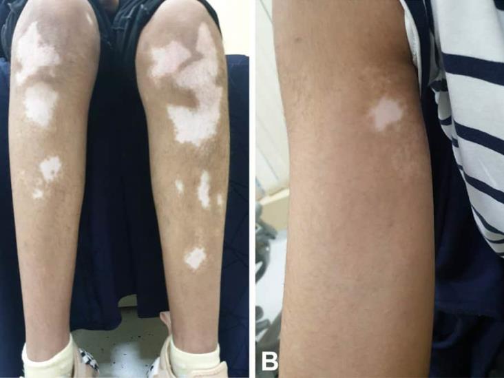 Autorizan venta de crema para tratar el vitíligo Autorizan venta de crema para tratar el vitíligo