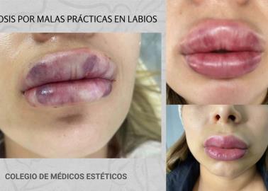Botox barato, una bandera roja para la salud: Presidente del Colegio de Médicos Estéticos en Sonora