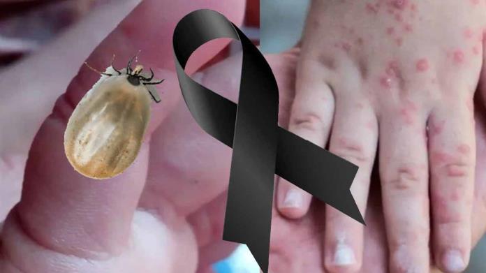 Rickettsia cobra vida de niña de 2 años Rickettsia cobra vida de niña de 2 años