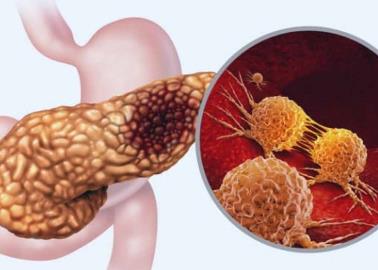 Alentadores resultados en vacuna contra el cáncer de páncreas