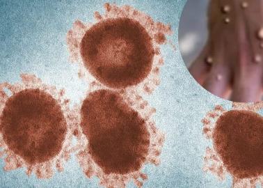 ¿Cómo son los granos de la viruela del mono?