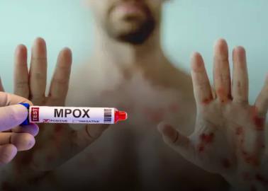 Mpox en Sonora: ¿Ya llegó el virus a la entidad?