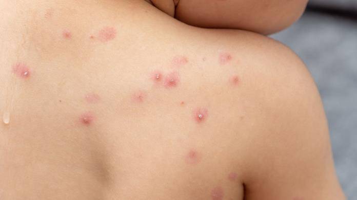Salud Sonora: Sin casos nuevos de viruela del mono Salud Sonora: Sin casos nuevos de viruela del mono