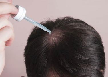 ¿Es bueno usar minoxidil para evitar la caída del cabello? Estos son los efectos secundarios