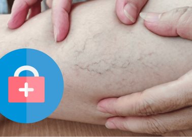 ¿Qué hacer para no tener varices en las piernas? Esto dicen los expertos