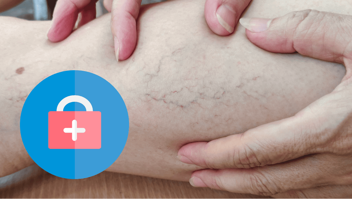 ¿Qué hacer para no tener varices en las piernas? Esto dicen los expertos