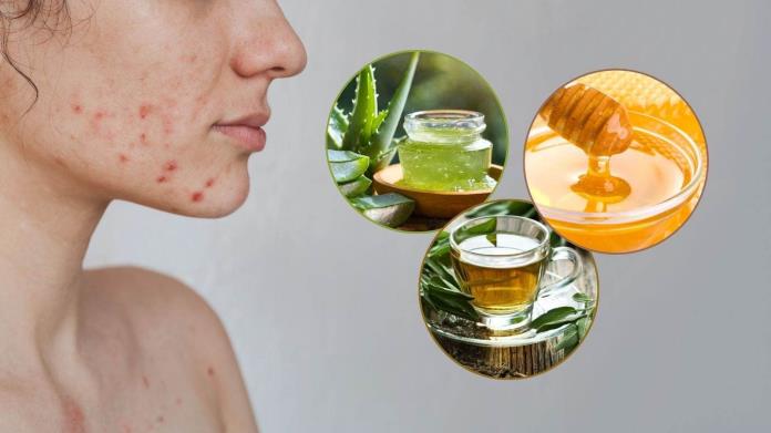 3 remedios naturales que te pueden ayudar a controlar el acné, según la Inteligencia Artificial