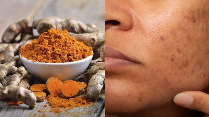 ¿Cómo usar la cúrcuma para reducir las manchas en la piel? Checa este consejo ¿Cómo usar la cúrcuma para reducir las manchas en la piel? Checa este consejo