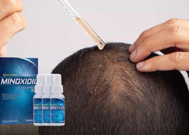 3 efectos adversos que el minoxidil puede tener en el cuerpo ¿Cuándo usarlo y para qué?