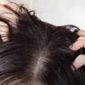 ¿Cómo eliminar la caspa y mantener un cuero cabelludo sano?