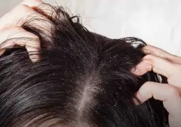 ¿Cómo eliminar la caspa y mantener un cuero cabelludo sano?