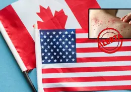 México alerta a quienes viajen a EU y Canadá por brote de sarampión