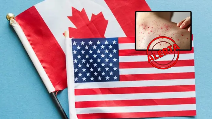 México alerta a quienes viajen a EU y Canadá por brote de sarampión