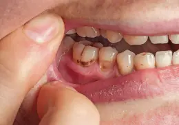 Caries es la enfermedad bucal más común en México: ¿cómo prevenirla?