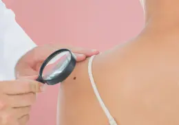 Día Mundial contra el Melanoma: síntomas y recomendaciones para prevenir el cáncer de piel