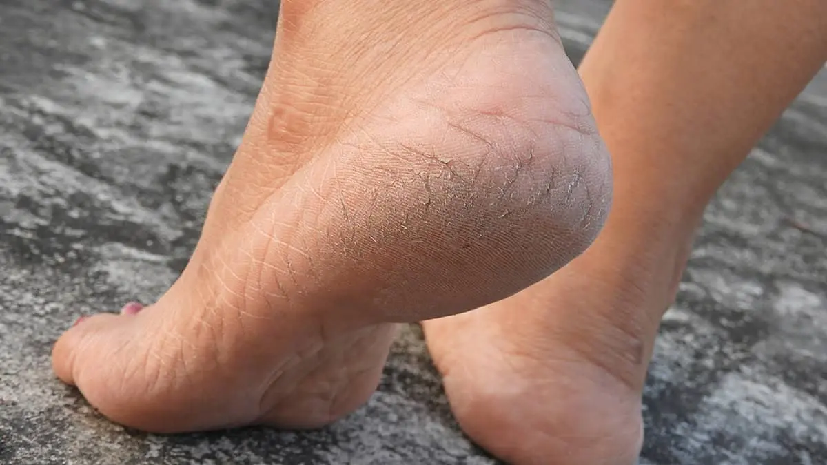 ¿Por qué se agrietan los pies y de qué forma se puede evitar este problema?