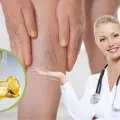 Dile adiós a las varices y arañitas de tus piernas con estas 3 poderosas vitaminas