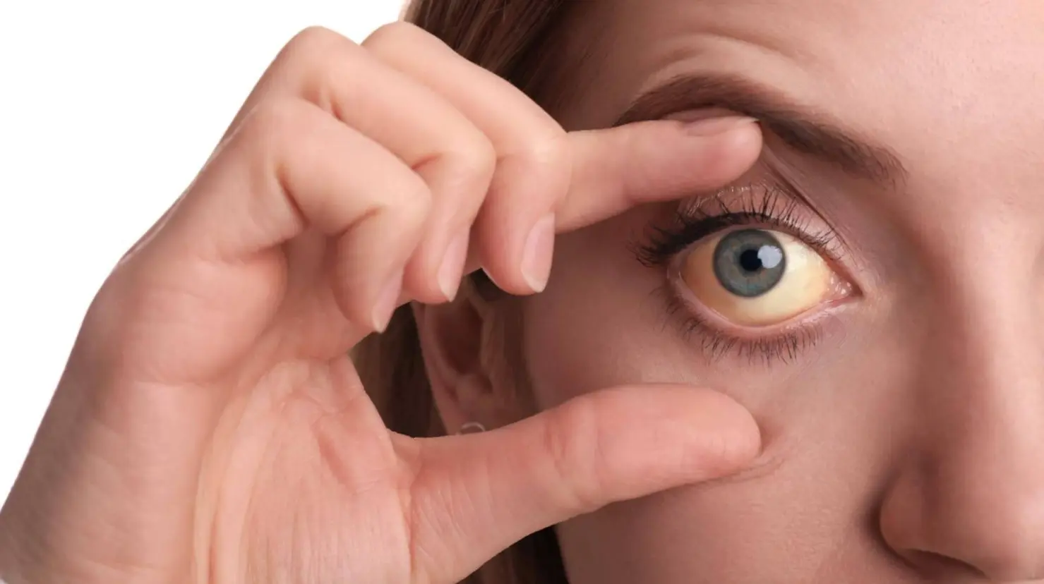 ¿Qué enfermedades pueden indicar los ojos amarillos y en qué momento preocuparse?