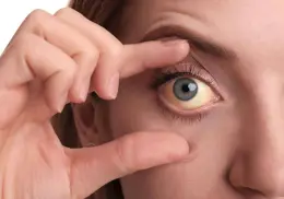 ¿Qué enfermedades pueden indicar los ojos amarillos y en qué momento preocuparse?