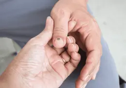 ¿Tienes manchas en las uñas? Podría significar enfermedades generales y síndromes