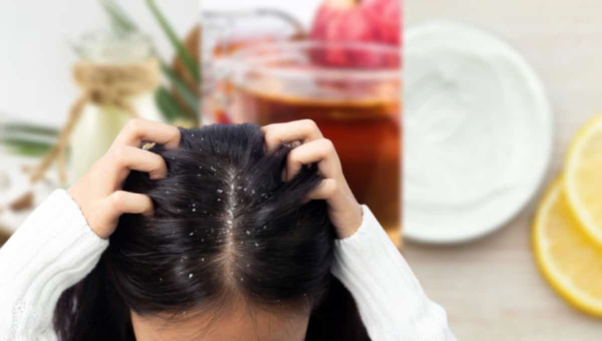 3 mascarillas para el cabello que pueden ayudarte a combatir la caspa