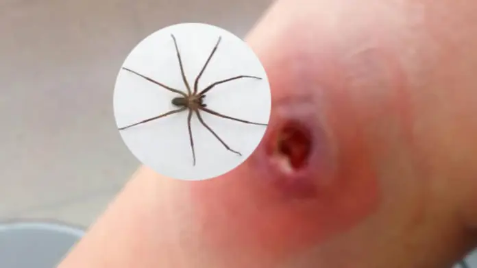 Alerta en México: aumentan casos de mordeduras de la araña violinista en 2025