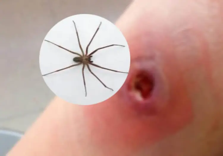 Alerta en México: aumentan casos de mordeduras de la araña violinista en 2025