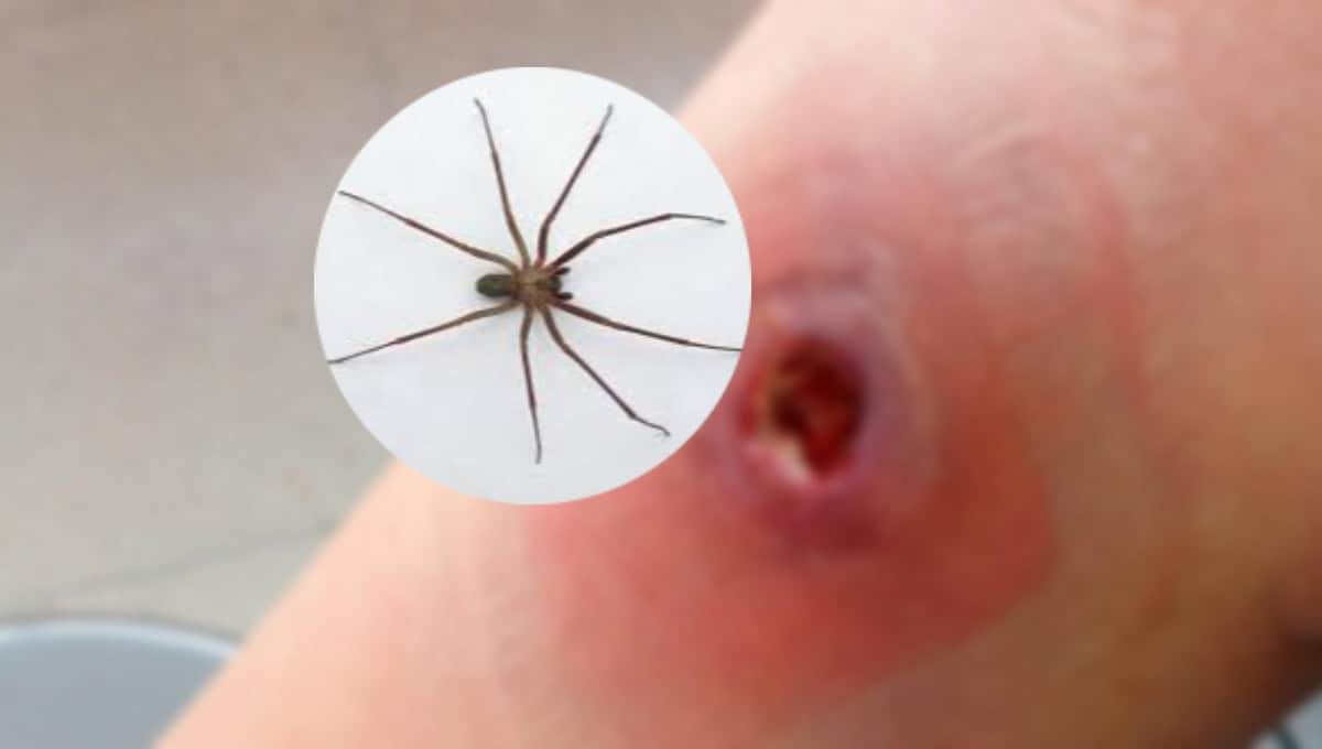 Alerta en México: aumentan casos de mordeduras de la araña violinista en 2025