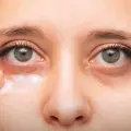 ¿Las ojeras se pueden operar? Estos son los métodos más efectivos para eliminarlas