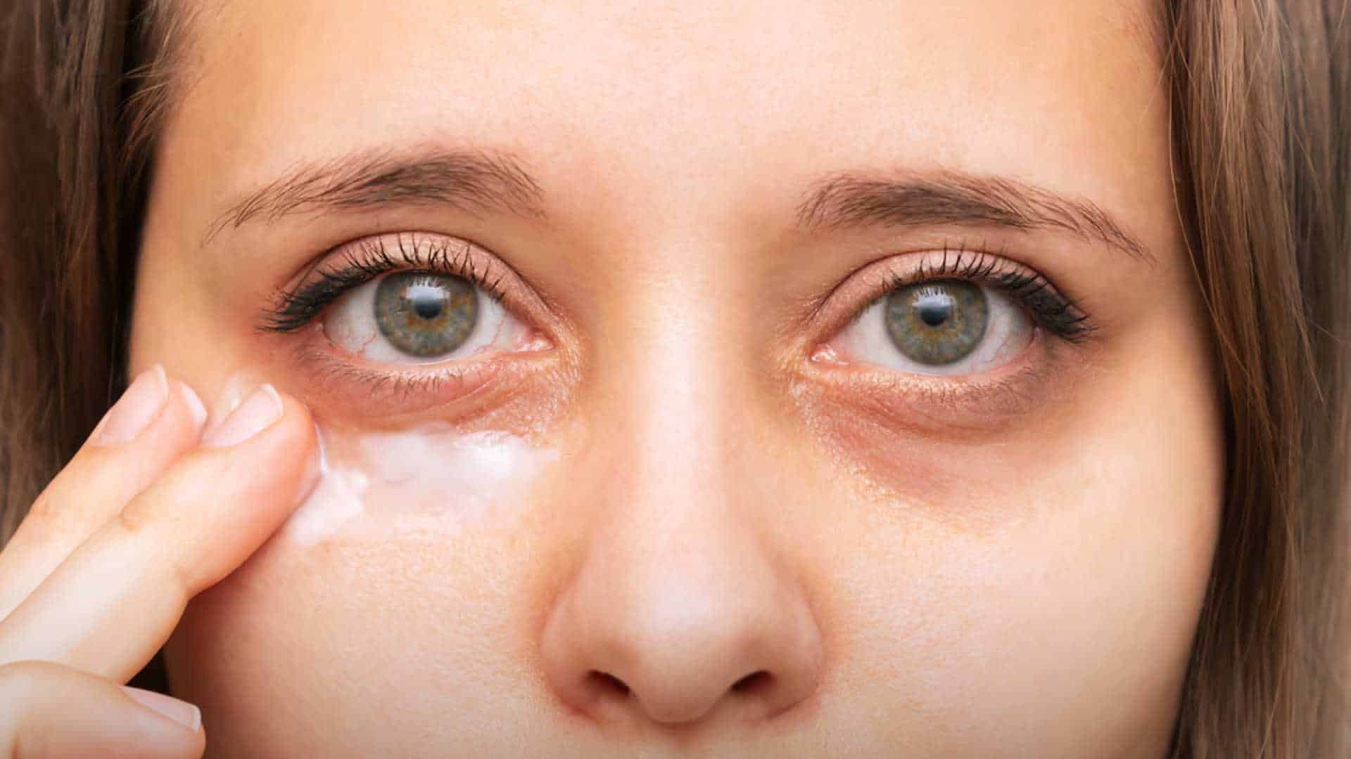 ¿Las ojeras se pueden operar? Estos son los métodos más efectivos para eliminarlas